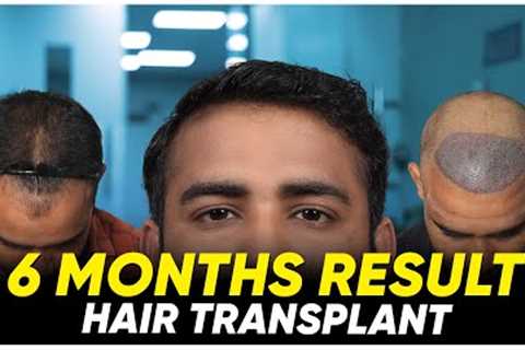 Hair Transplant in Vijayapura | Best Results &amp; Cost of Hair Transplant in Vijayapura