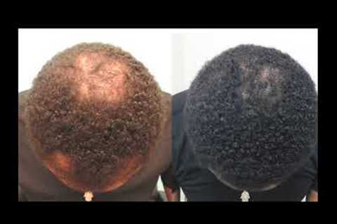 Hair Loss Treatment for Men - Black Men Hair Loss no Surgery