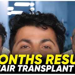 Hair Transplant in Salem | Best Results & Cost of Hair Transplant in Salem