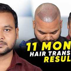 Hair Transplant in Bangkok | Best Results & Cost of Hair Transplant in Bangkok