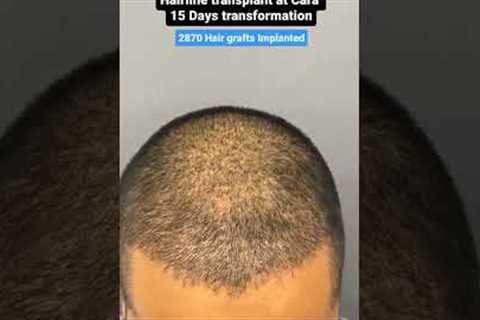 15 DAY TRANSFORMATION: See His Hair Before and After Sapphire FUE Hair Transplant