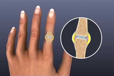 Mayo Clinic Minute: Fighting arthritis with food
