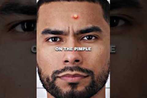 Zuniga on Why You're STILL Getting Pimples