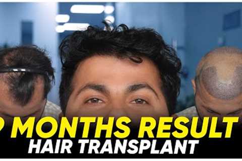 Hair Transplant in Salem | Best Results &amp; Cost of Hair Transplant in Salem