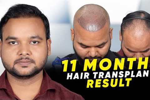 Hair Transplant in Bangkok | Best Results &amp; Cost of Hair Transplant in Bangkok
