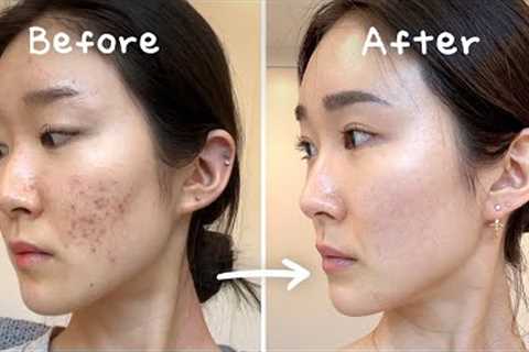 3 Secrets to Clearing Acne Without Medication (No Accutane / Tretinoin)