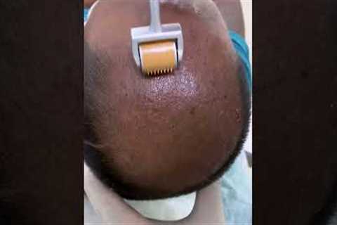 PRP - Best hair loss treatment | Hair loss treatment | derma roller hair regrowth | Skinaa Clinic