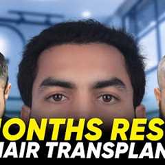 Hair Transplant in Perth | Best Results & Cost of Hair Transplant in Perth