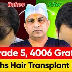 Shocking Hair Growth Results in India (4006 Grafts, Norwood Grade 5) | Hair Transplant Cost