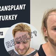 Hair Transplant Before and After Operation | 4300 Grafts Hair Transplant | Hair Transplant in Turkey