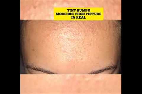 MY TINY BUMPS/MASK ACNE JOURNEY|SHORTS #shorts