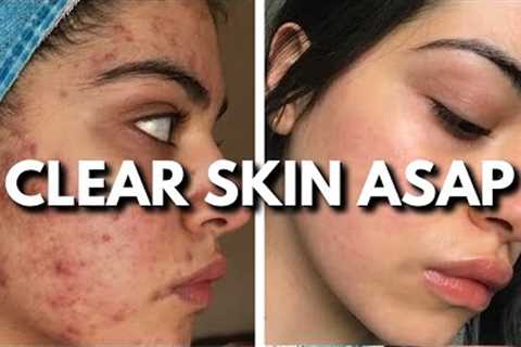 Clear Your Skin: The Ultimate Acne Routine for Breakouts, Dry Skin &amp; More!