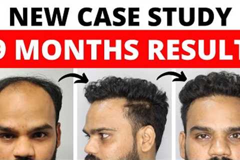 My Hair Transplant Result After 9 Months