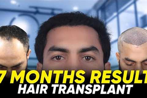 Hair Transplant in Perth | Best Results &amp; Cost of Hair Transplant in Perth