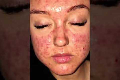 1 product that changed my life 😱🤩❤️ #shorts #acne #skincare