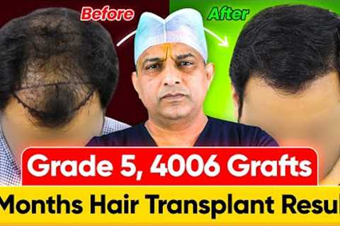 Shocking Hair Growth Results in India (4006 Grafts, Norwood Grade 5) | Hair Transplant Cost
