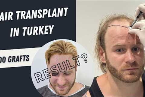 Hair Transplant Before and After Operation | 4300 Grafts Hair Transplant | Hair Transplant in Turkey