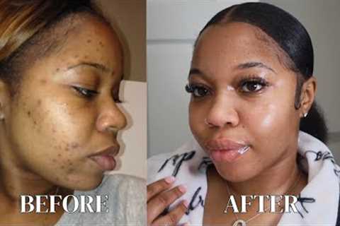 HOW I CLEARED MY ACNE &amp; DARK SPOTS | 2025 UPDATED GLASS SKINCARE ROUTINE