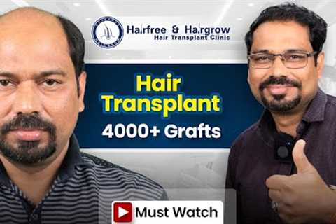 Grade 7 Hair Transplant in Surat | Stunning Hair Transplant Results and Best Cost in Surat