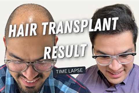 Hair Transplant Result | Hair Transplant Before and After | Hair Transplant in Turkey Time lapse