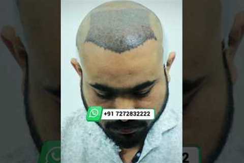 Best Hair Transplant Surgery in India | Hair Transplant Before and After #hairtransplant #shorts
