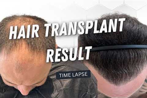 Hair Transplant 5200 Grafts Before and After | Hair Transplant  Time Lapse | Hair Transplant Result