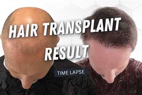 Hair Transplant 5000 Grafts Before and After | Hair Transplant  Time Lapse | Hair Transplant Result