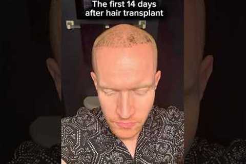 Hair Transplant Results: What Happens in the First 14 Days? (Shocking!)