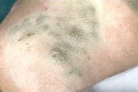 Big Cystic Acne Blackheads Extraction Blackheads &amp; Milia, Whiteheads Removal Pimple Popping