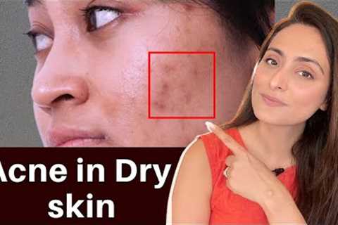 Acne in Dry Skin | what to use | serums, creams | Dermatologist recommends