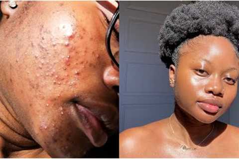 my skincare routine for acne &amp; scars... finally