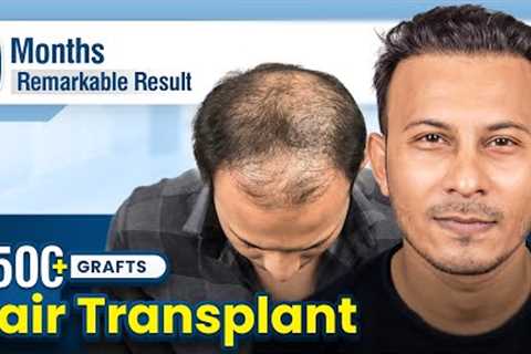 Grade 5 Hair Transplant in Bangalore | Amazing Hair Transplant Results &amp; Cost in Bangalore