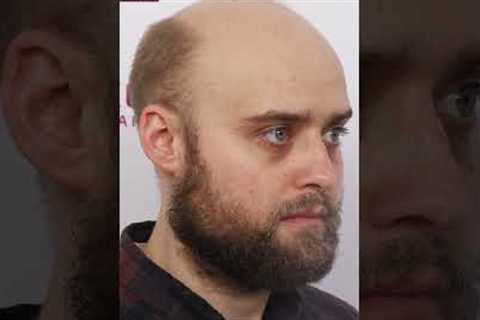 Inspiring Hair Transplant Results: A Journey from United Kingdom to Eugenix!