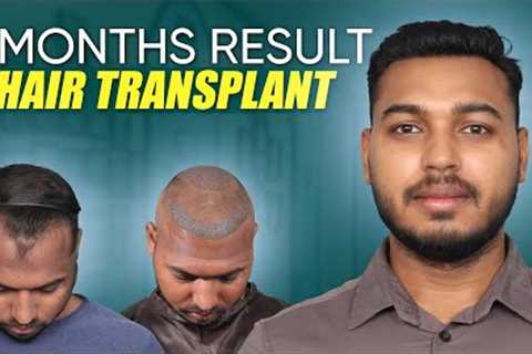 Hair Transplant in Vellore | Best Results &amp; Cost of Hair Transplant in Vellore