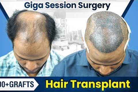 Giga Session Hair Transplant in Pune | Hair Transplant Results &amp; Cost in Pune #hairtransplant