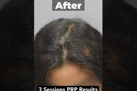 PRP Results Before &amp; After 2 Sessions  #prptreatment #hairlosstreatment