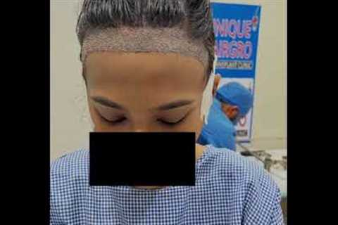 Female Hair transplant | Unique Hair grow Chennai | best hair transplant in chennai