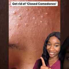 Closed comedones #closedcomedones