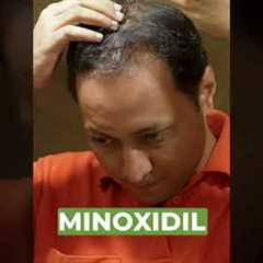 Dr. Agni, Dermatologist explains the real reason why minoxidil causes increased hair fall