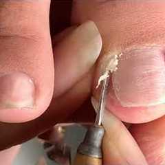 Clean the Skin and remove the corner of the nail#481