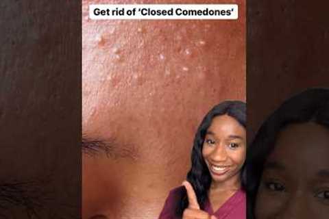 Closed comedones #closedcomedones