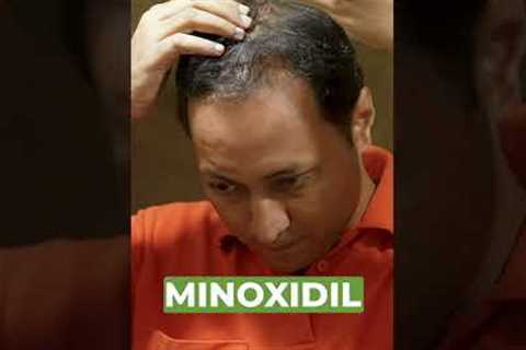 Dr. Agni, Dermatologist explains the real reason why minoxidil causes increased hair fall