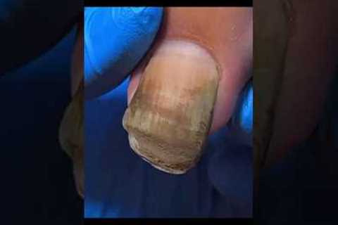Nail cleaning-pedicure doctornail4