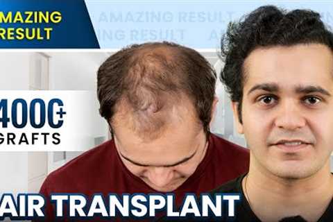 Grade 5 Hair Transplant in Surat | Stunning Hair Transplant Results and Cost #hairtransplant