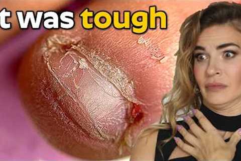 Best Bitten Nails Transformations | Growth &amp; Recovery