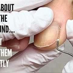 Do not cut your nails like this to avoid painful corners.