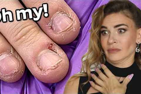 Bitten Nails Transformation to Natural Looking Acrylic Extensions