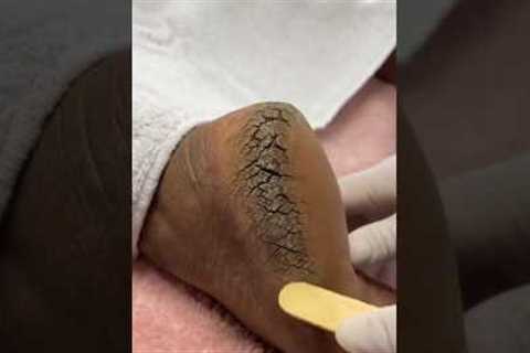 Pedicure extraction foot cleaning