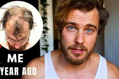 Preventing Balding: What I Did Before It Was Too Late.