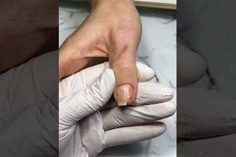 Broken nail repair and red French manicure